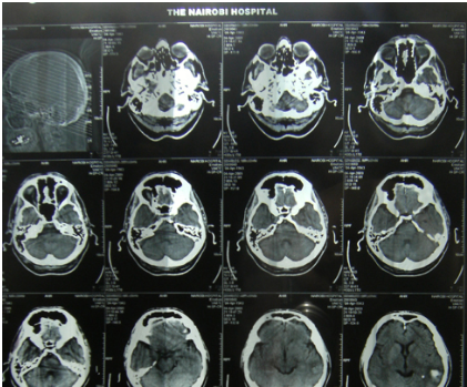 Global Rescue proporciona evacuación médica a un cazador en Etiopía